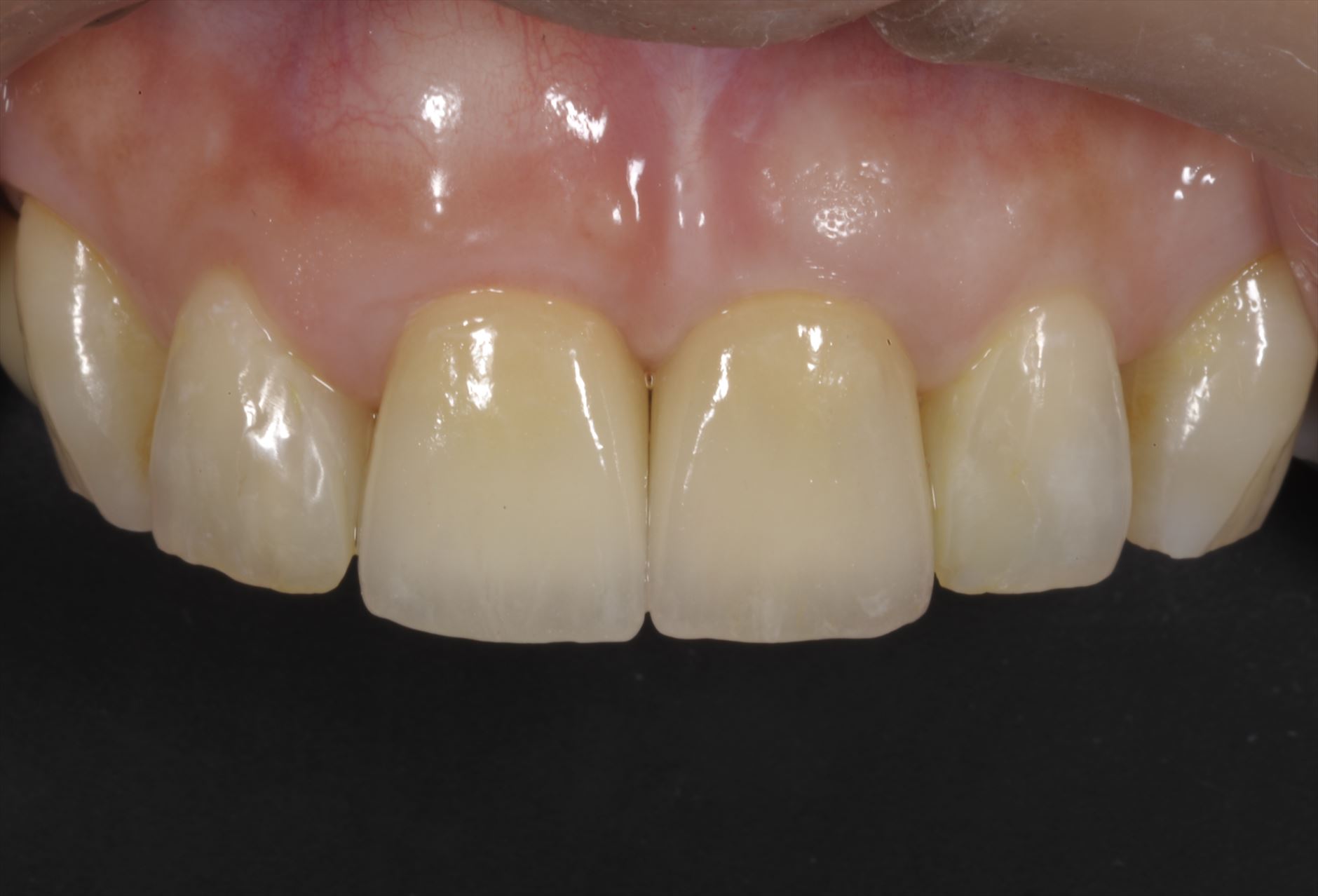 前歯部をスマイルテクニックでのインプラント治療症例