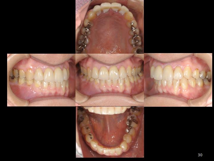 矯正治療と前歯部の審美修復した症例