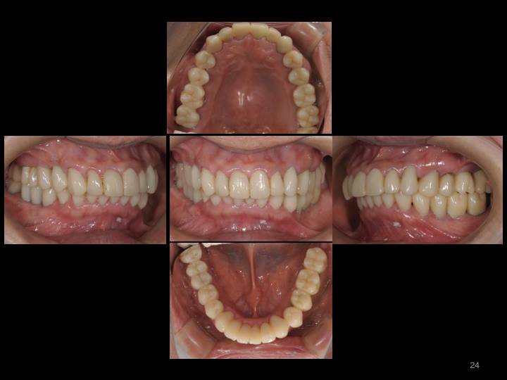 歯周病で崩壊した歯周組織及び咬み合わせを再生した症例