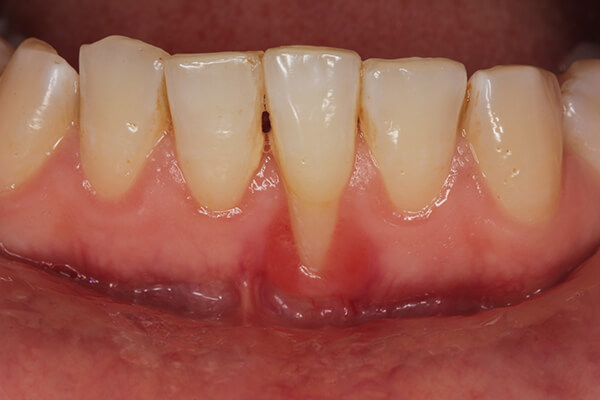 歯周病による骨の吸収