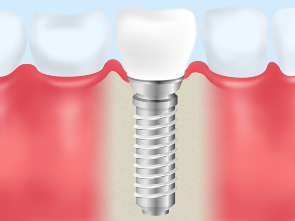 治療期間を削減する「抜歯即時インプラント」