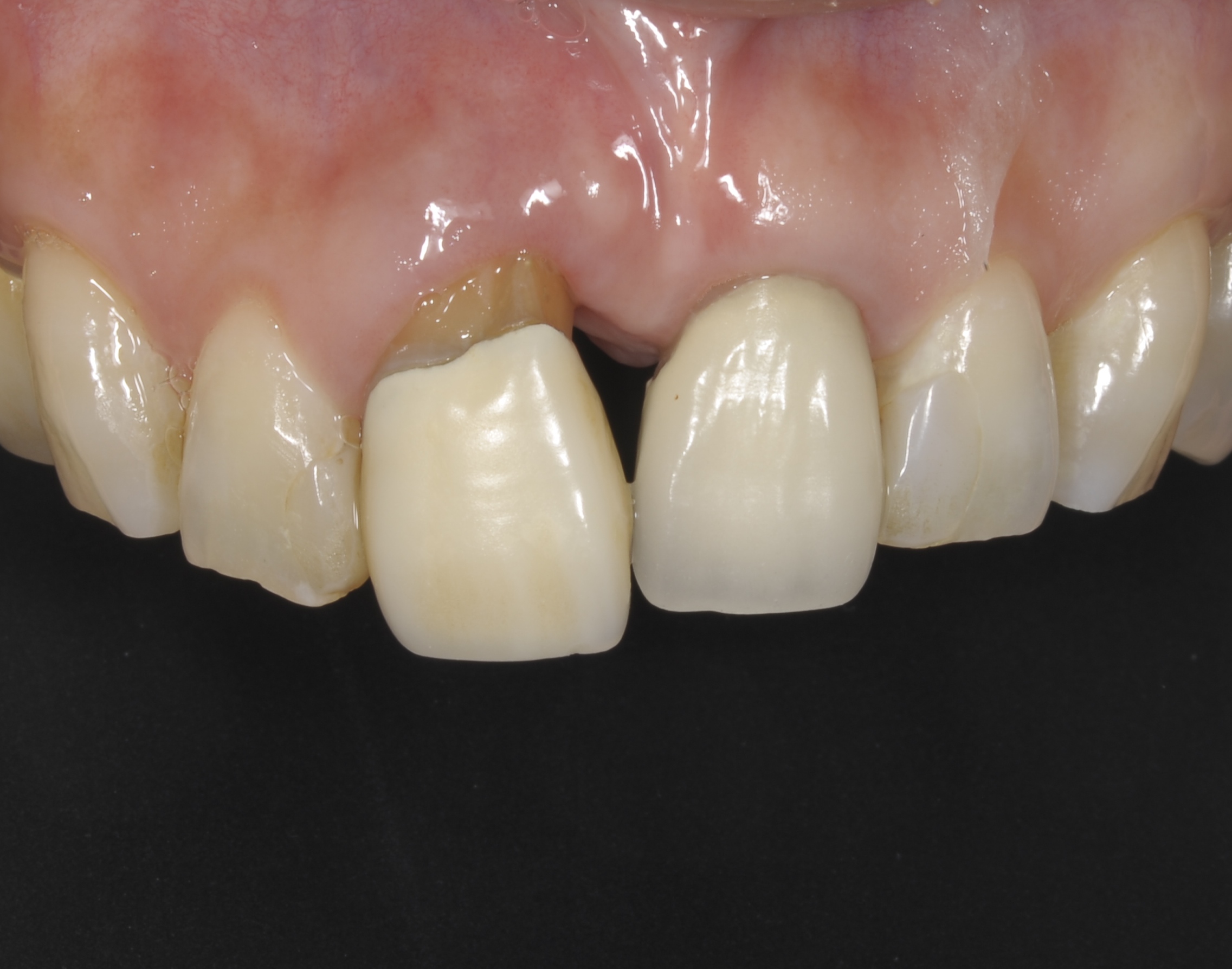 前歯部をスマイルテクニックでのインプラント治療症例