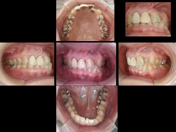矯正治療と前歯部の審美修復した症例