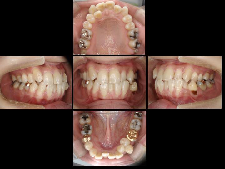 叢生の歯並びを治療