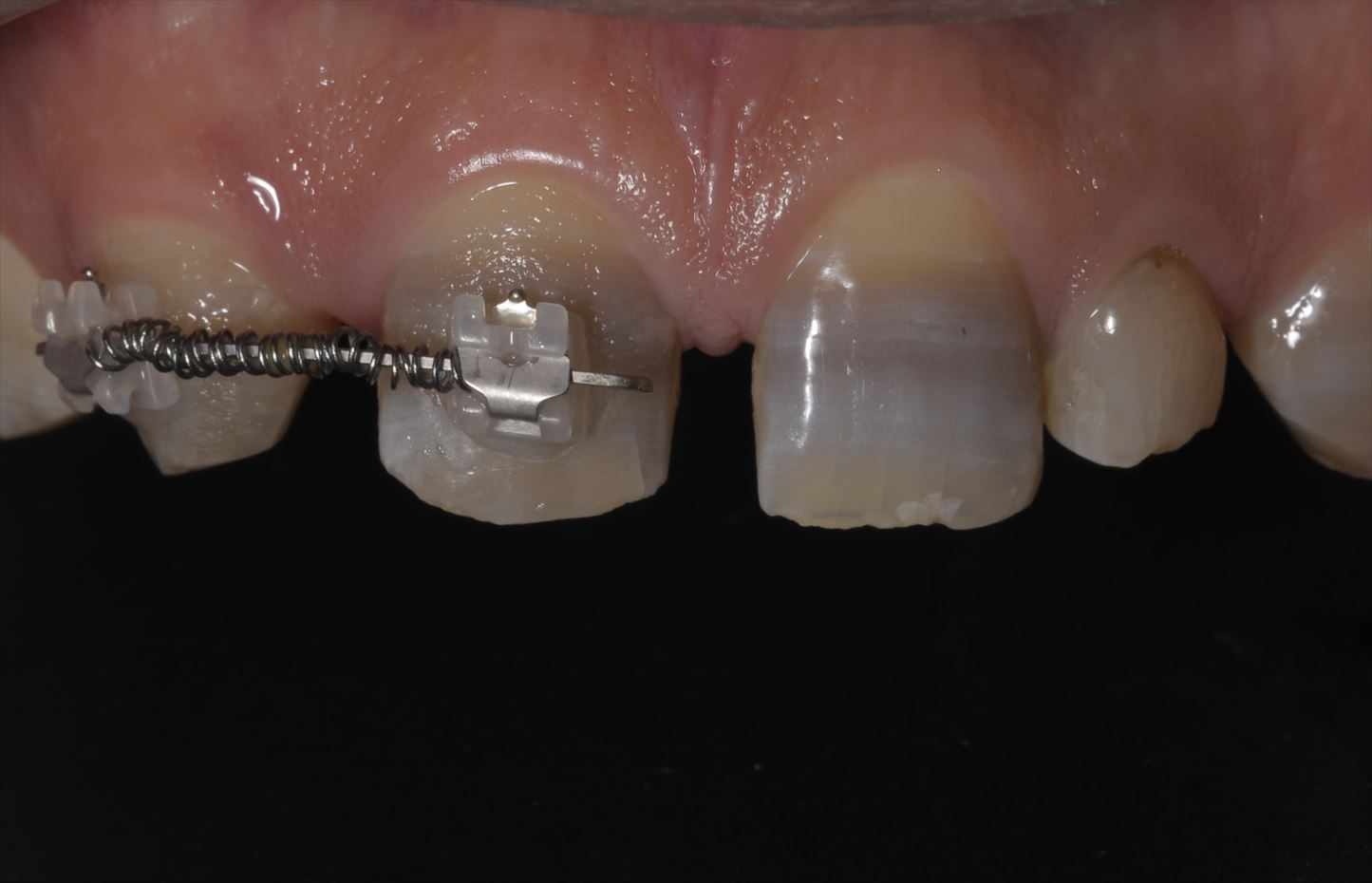 先天性欠如歯で変色歯を審美的に回復した症例