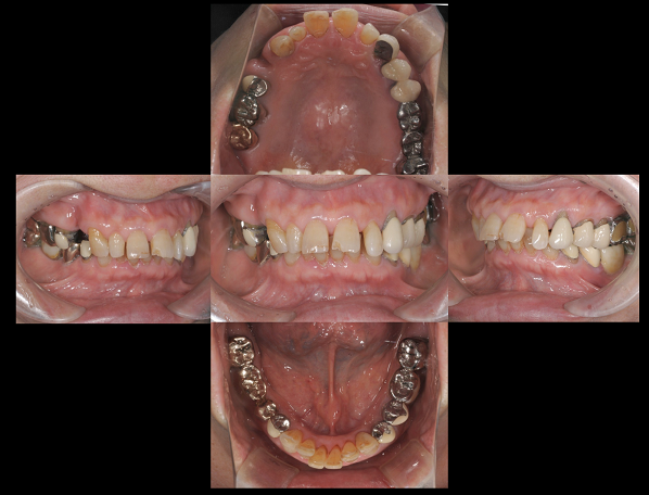 歯周病により歯が揺れ抜けて咬みあわせが崩壊してきた症例。