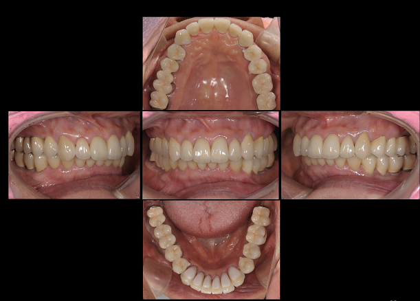 歯周病により歯が揺れ抜けて咬みあわせが崩壊してきた症例。
